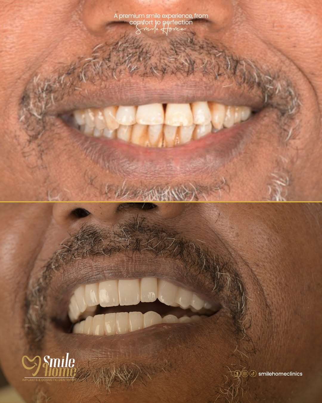 Hollywood Smile